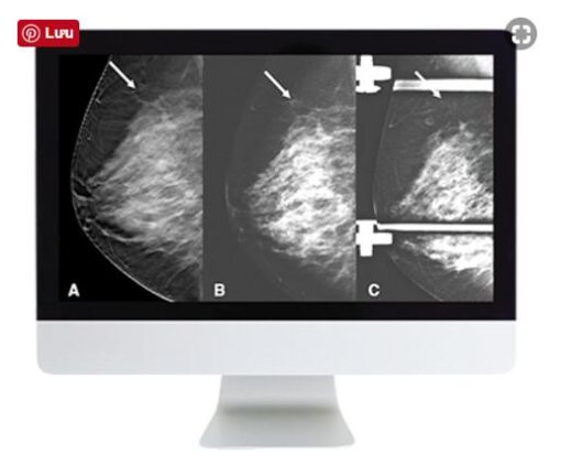 Breast Imaging: Screening and Diagnosis