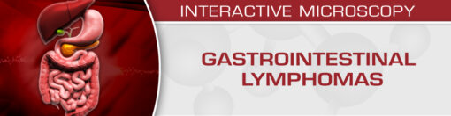 Gastrointestinal Lymphomas