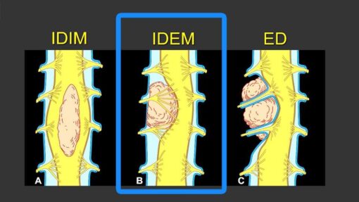 MRI Mastery Series: Intradural Extramedullary Lesions (IDEM) 2020