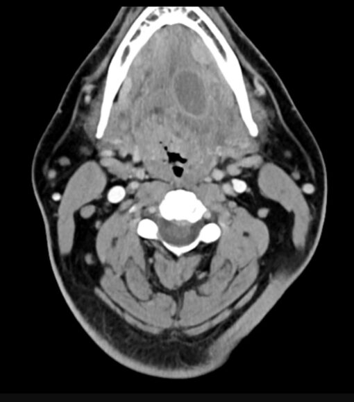 Imaging Mastery Series: Pathology of the Oral Cavity and Oropharynx 2020