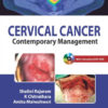 Cervical Cancer: Contemporary Management