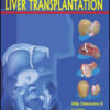 Liver Transplantation