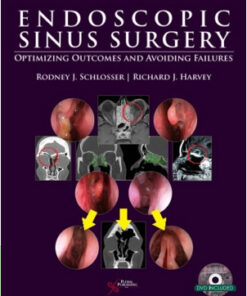 Endoscopic Sinus Surgery: Optimizing Outcomes and Avoiding Failures