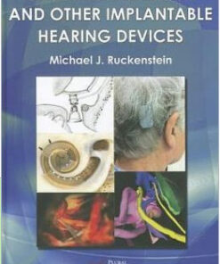 Cochlear Implants and Other Implantable Hearing Devices