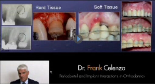 Implant Interactions in Orthodontics