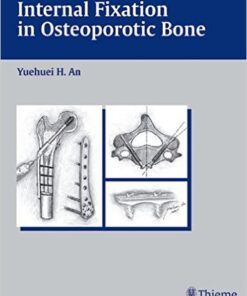 Internal Fixation in Osteoporotic Bone 1st Edition