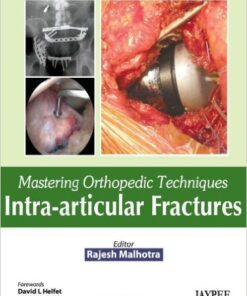 Mastering Orthopedic Techniques: Intra-articular Fractures 1st Edition