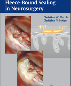 Hemostasis and Fleece-Bound Sealing in Neurosurgery PDF