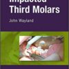 Impacted Third Molars PDF