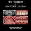 New Frontiers In Immediate Loading PDF