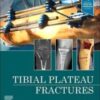 Tibial Plateau Fractures