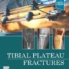 Tibial Plateau Fractures