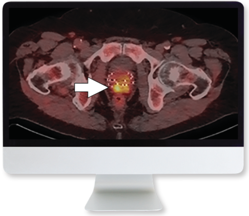 Molecular Imaging and Therapy of Prostate Cancer 2020 (CME VIDEOS)