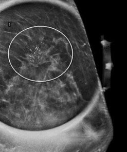 mrionline-imaging-mastery-series-high-risk-screening-breast-mri-2021