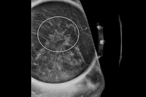 mrionline-imaging-mastery-series-high-risk-screening-breast-mri-2021