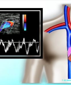 Mastering Upper Extremity Duplex – AllAboutUltrasound