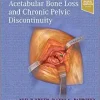 Treatment of Acetabular Bone Loss and Chronic Pelvic Discontinuity