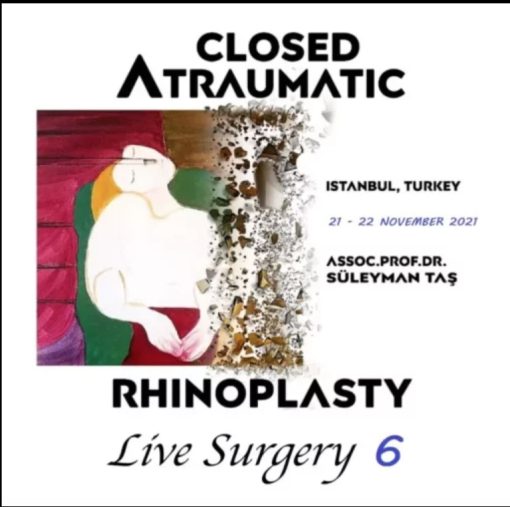 Closed Atraumatic Rhinoplasty Live Surgery