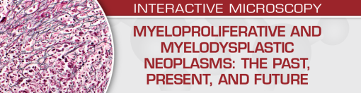 Myeloproliferative and Myelodysplastic Neoplasms: The Past, Present, and Future ? USCAP (Videos)