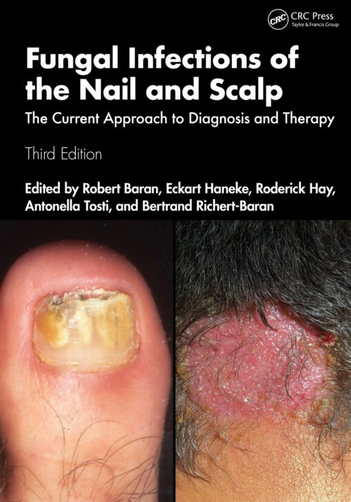 Fungal Infections of the Nail and Scalp: The Current Approach to Diagnosis and Therapy, 3rd Edition (EPUB)